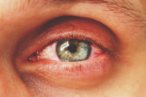Wat is een oogontsteking